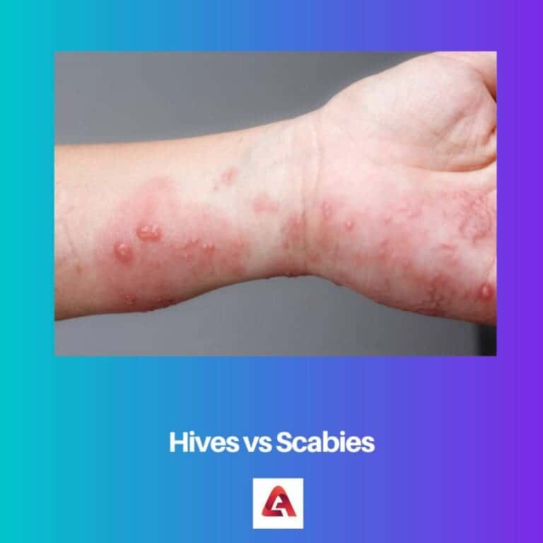 Hives Vs Scabies Difference And Comparison 