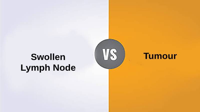 Swollen Lymph Node vs Tumor