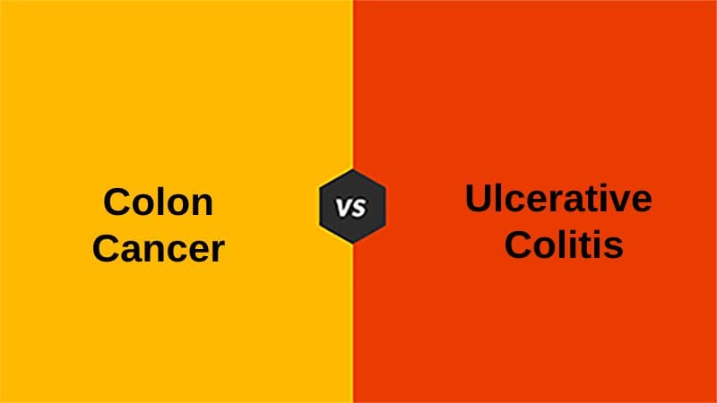 Colon Cancer and Ulcerative Colitis