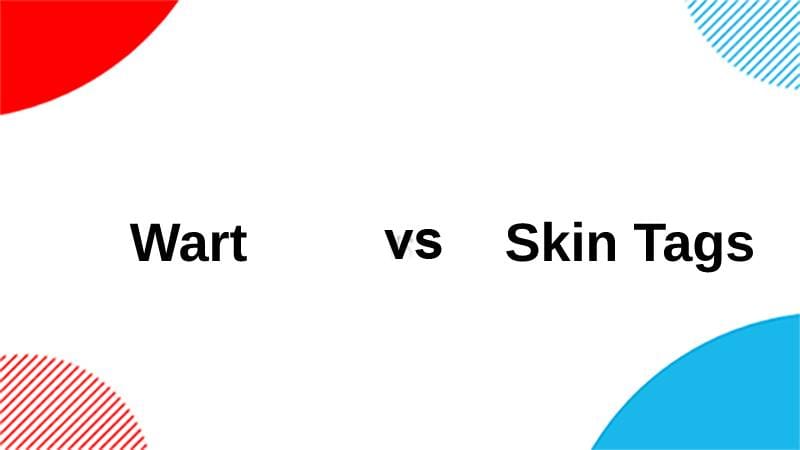 Wart vs Skin Tags
