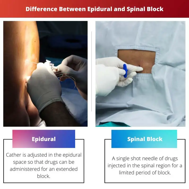 Difference Between Epidural and Spinal Block