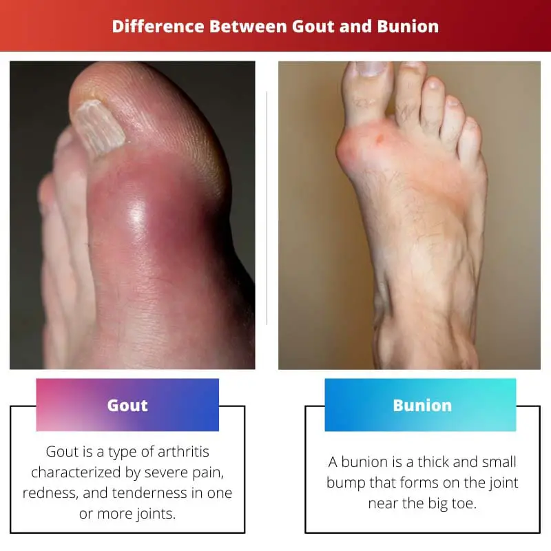 Sự khác biệt giữa bệnh gút và Bunion