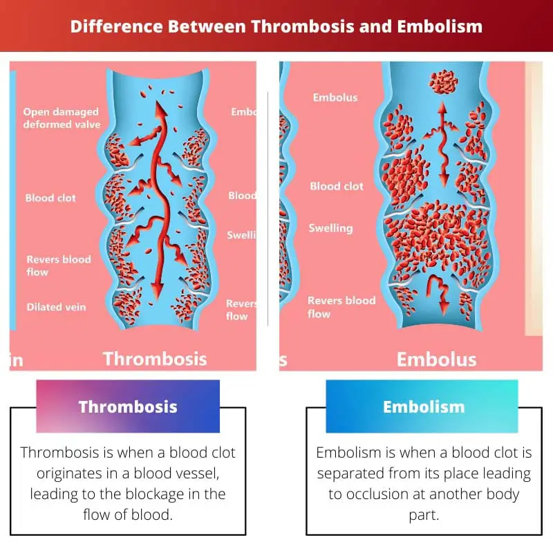 Difference Between Thrombosis and Embolism
