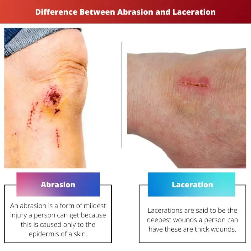 Diferencia entre abrasión y laceración