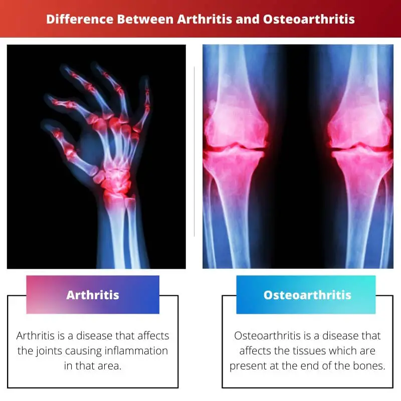 Differenza tra artrite e osteoartrite