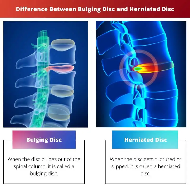 Diferença entre abaulamento de disco e hérnia de disco