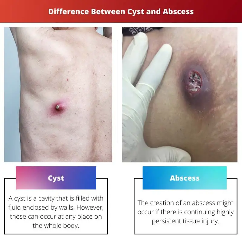 Difference Between Cyst and Abscess