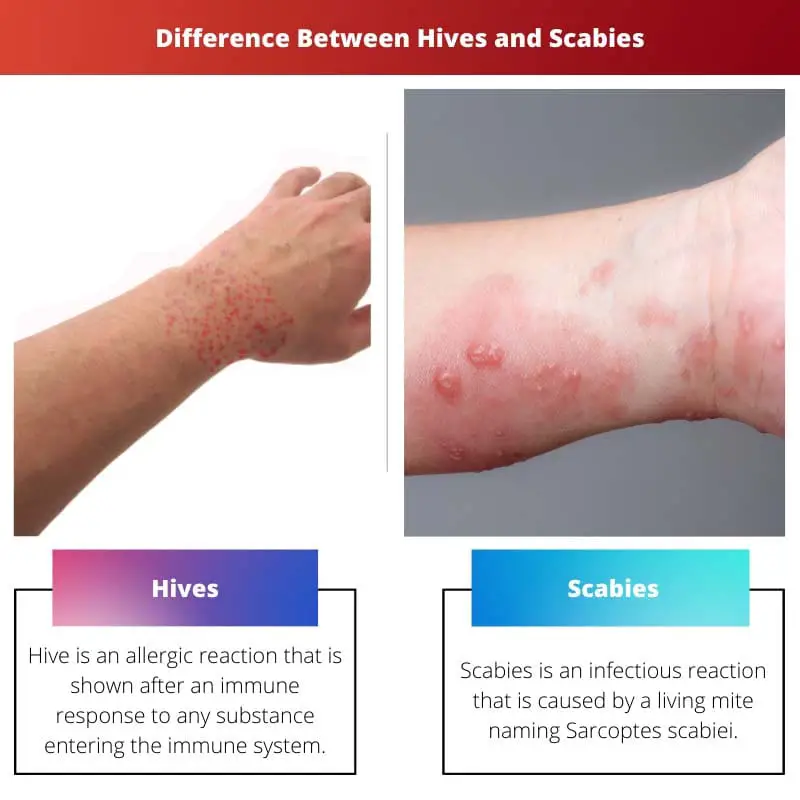 Difference Between Hives and Scabies