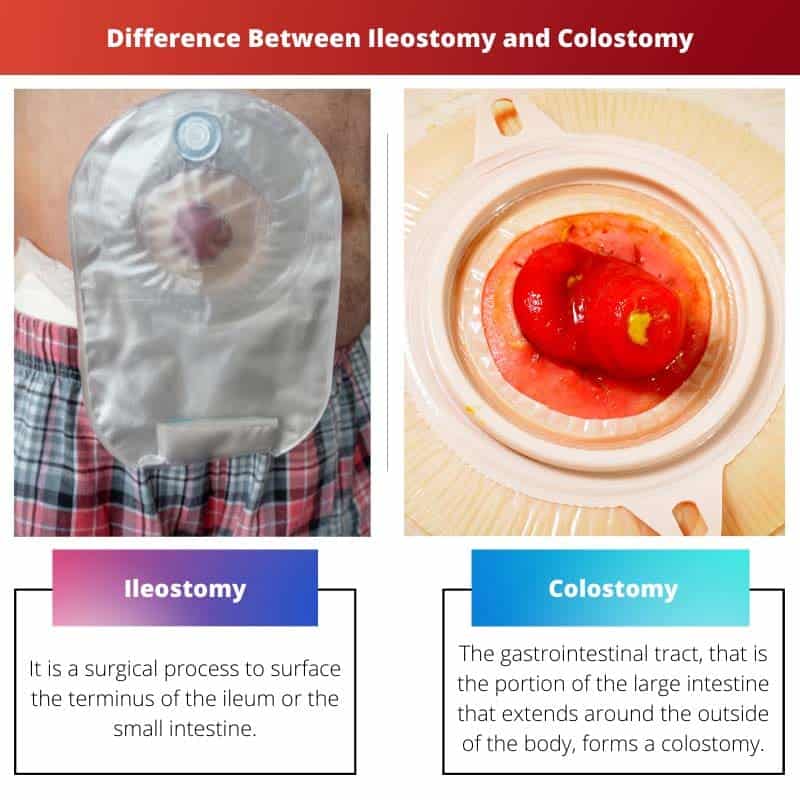 Perbedaan Antara Ileostomi dan Kolostomi