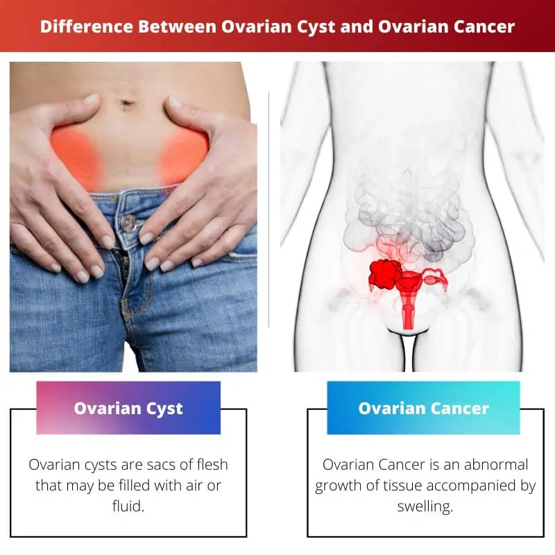 Unterschied zwischen Eierstockzyste und Eierstockkrebs