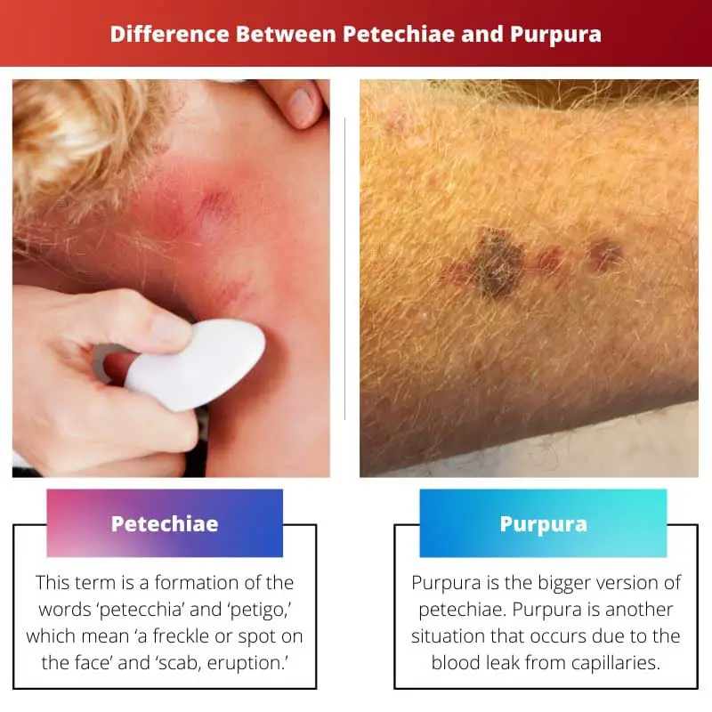 Difference Between Petechiae and Purpura