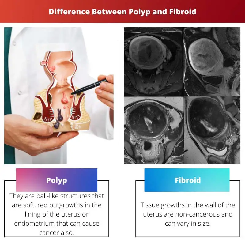 Diferença entre pólipo e mioma