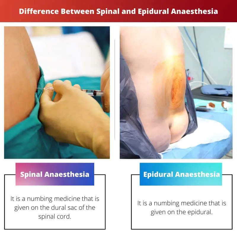 Difference Between Spinal and Epidural Anaesthesia