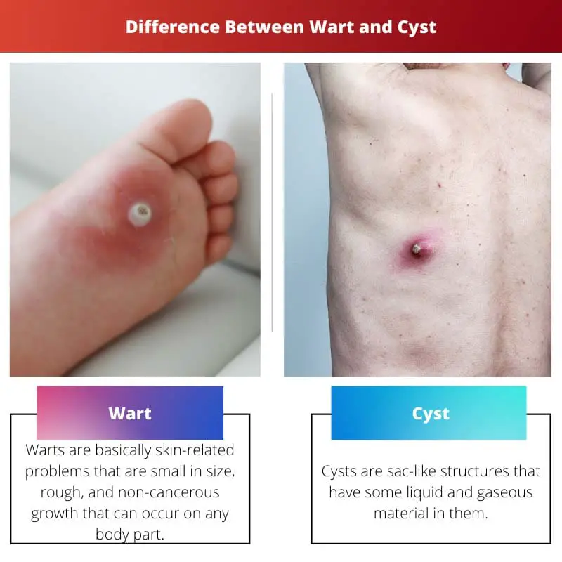 Difference Between Wart and Cyst