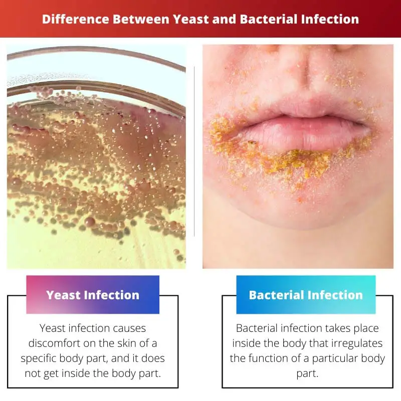 Sự khác biệt giữa nhiễm trùng nấm men và vi khuẩn