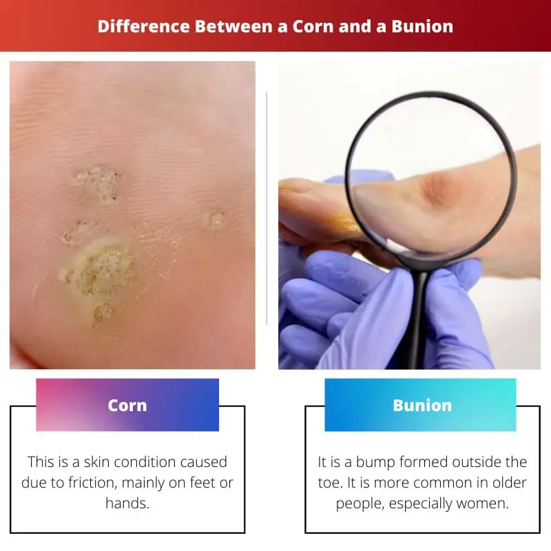 Difference Between a Corn and a Bunion