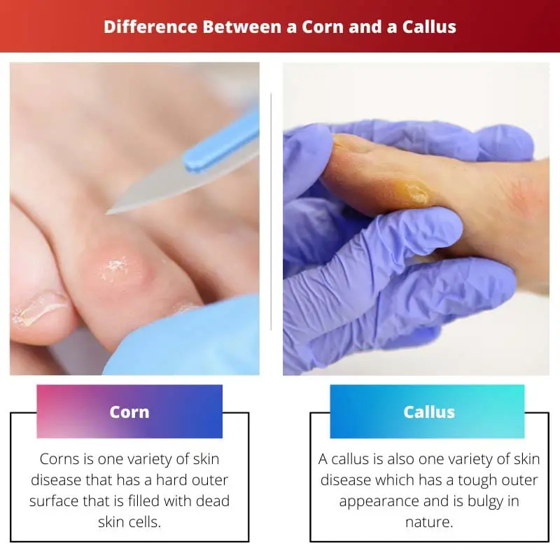 Difference Between a Corn and a Callus