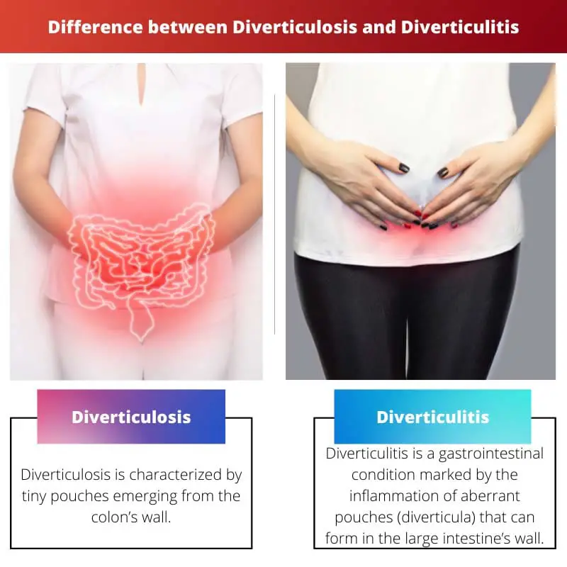 Difference between Diverticulosis and Diverticulitis