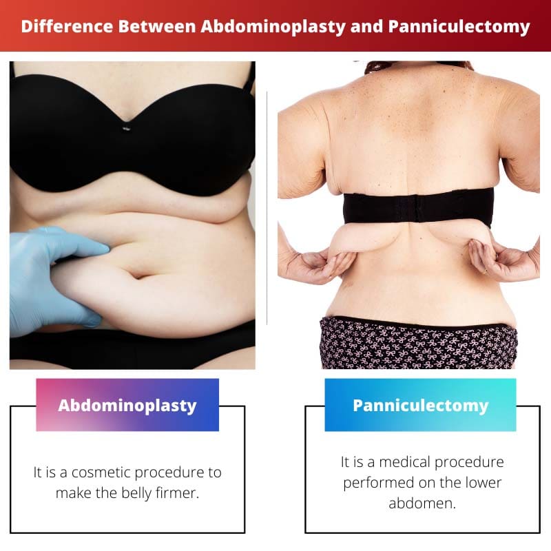 Difference Between Abdominoplasty and Panniculectomy