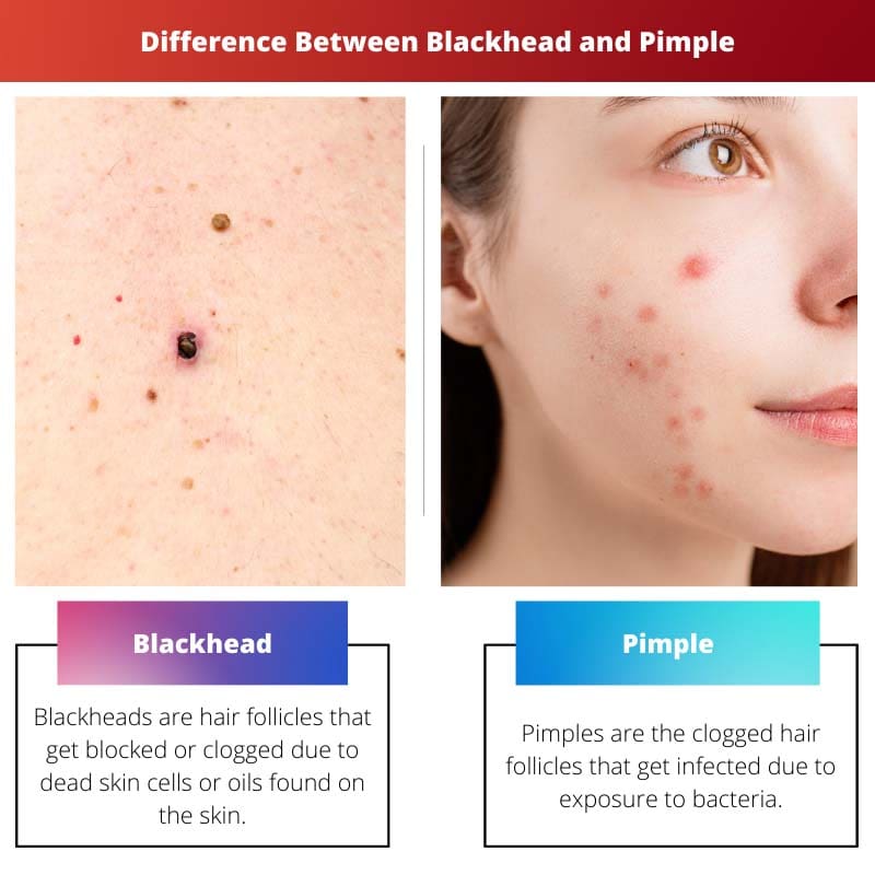 Difference Between Blackhead and Pimple