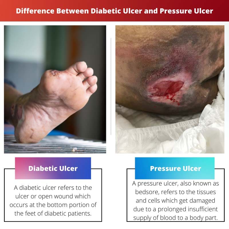 Difference Between Diabetic Ulcer and Pressure Ulcer