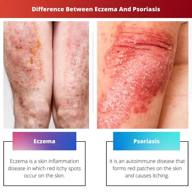 Diferença entre eczema e psoríase