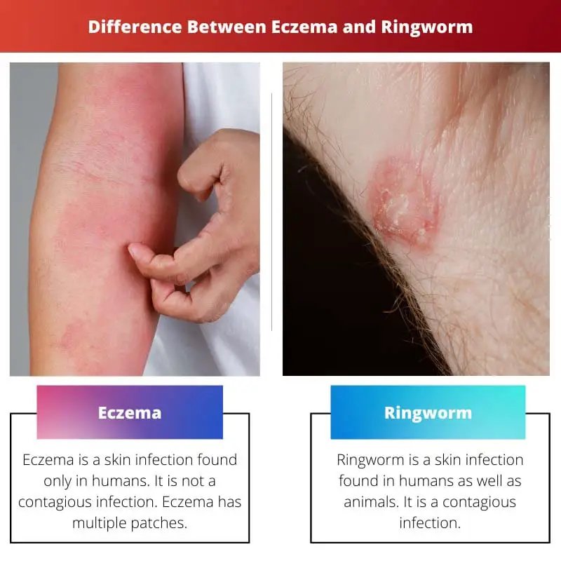 Difference Between Eczema and Ringworm
