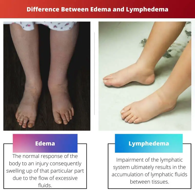 Difference Between Edema and Lymphedema