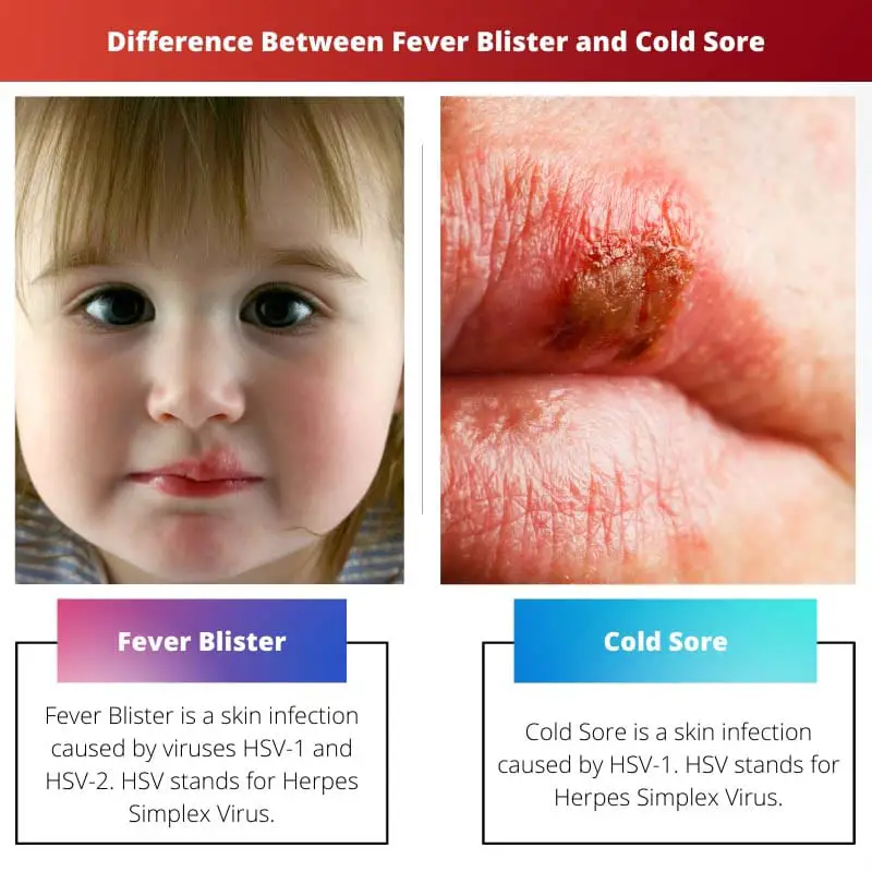 Differenza tra febbre blister e herpes labiale