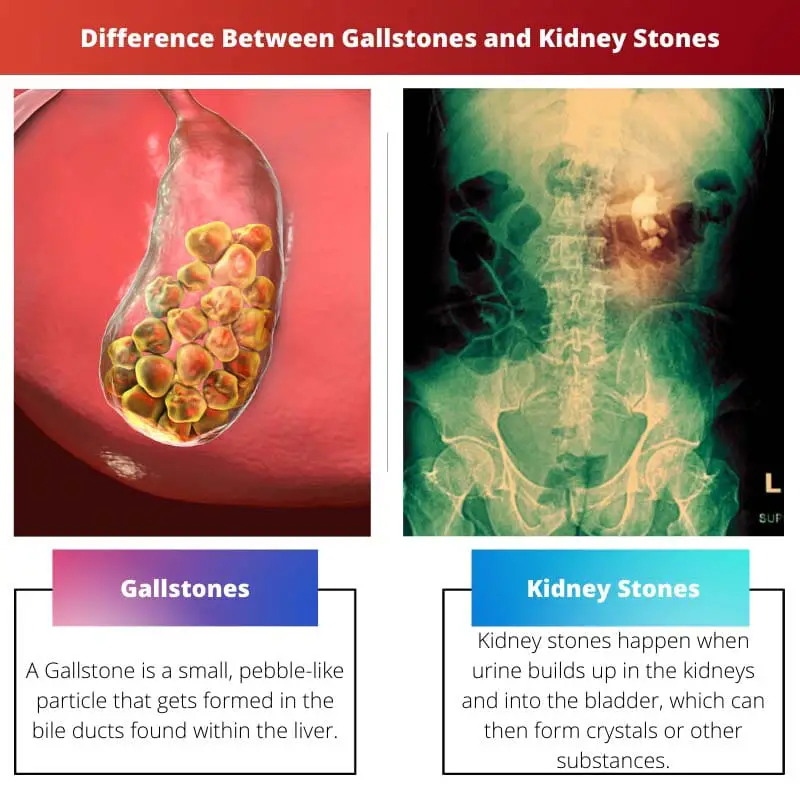 Unterschied zwischen Gallensteinen und Nierensteinen
