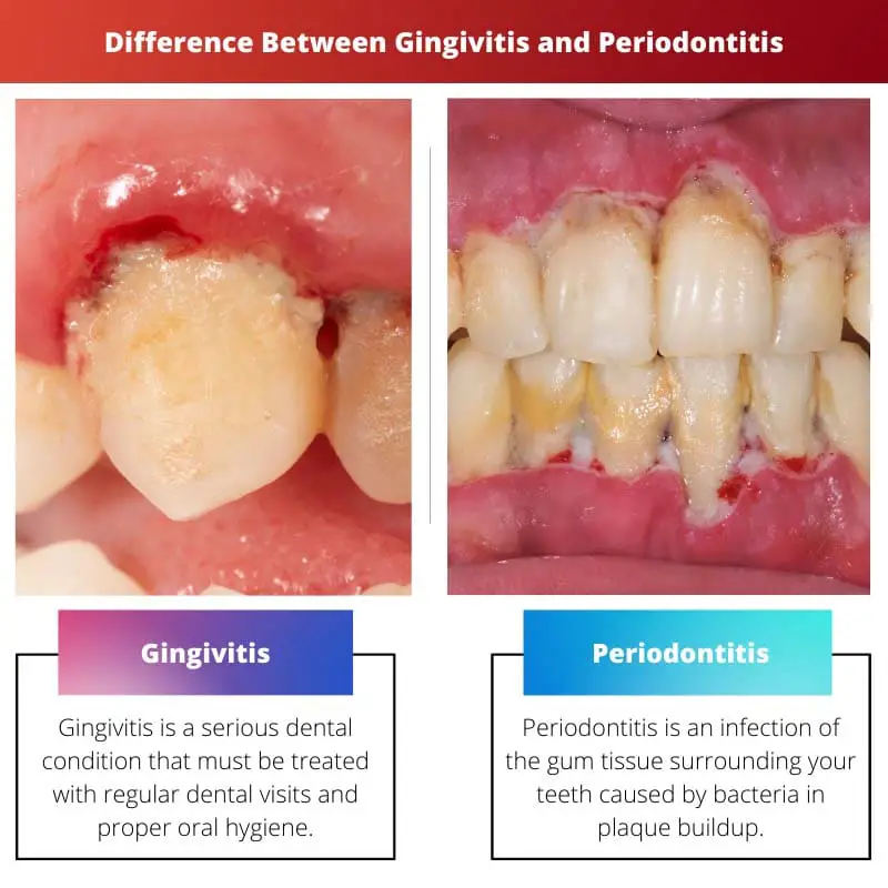 Difference Between Gingivitis and Periodontitis