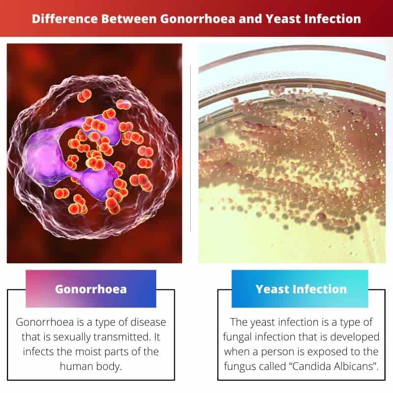 Verschil tussen gonorroe en schimmelinfectie