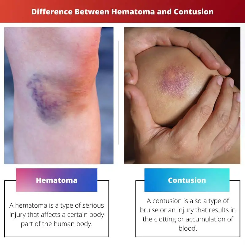 Difference Between Hematoma and Contusion
