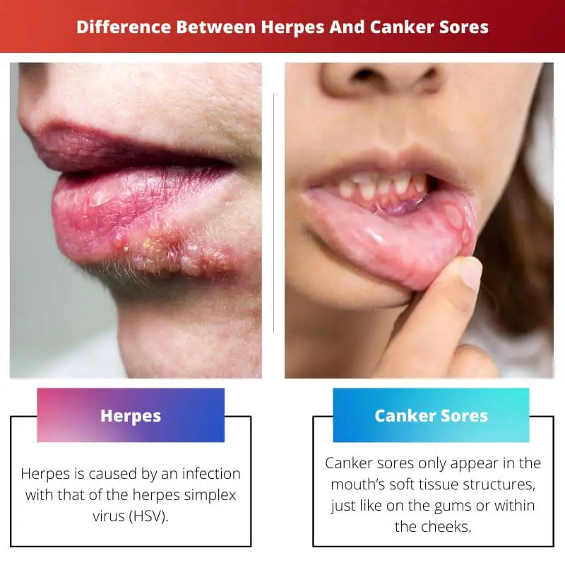 Erinevus herpese ja haavandite vahel