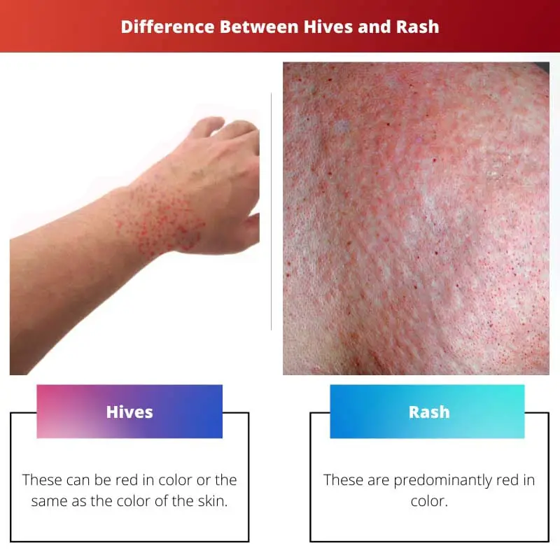 Difference Between Hives and Rash