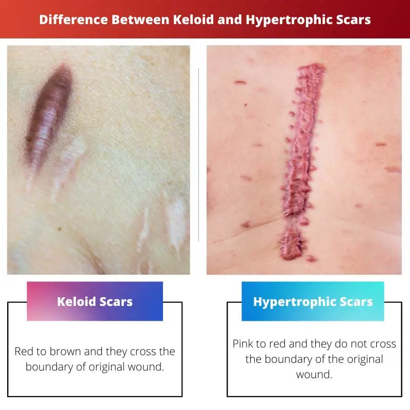 Difference Between Keloid and Hypertrophic Scars