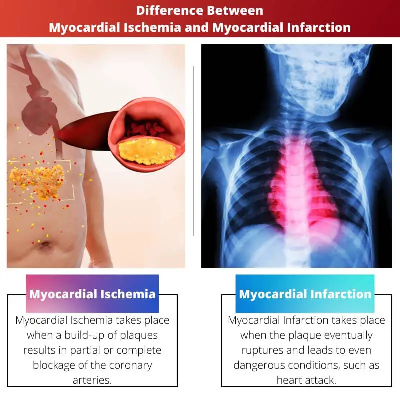 Difference Between Myocardial Ischemia and Myocardial Infarction