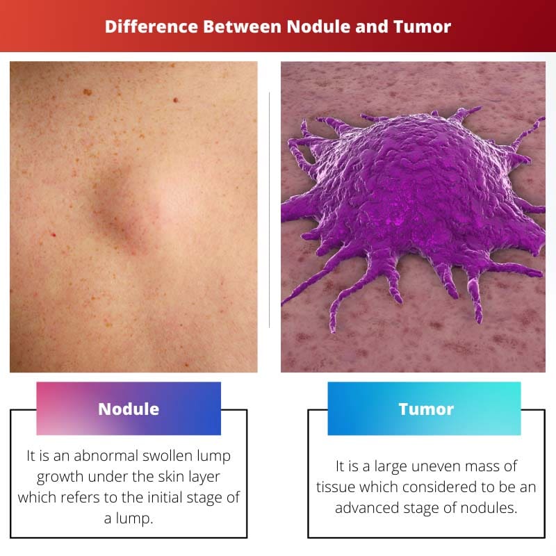 Différence entre nodule et tumeur