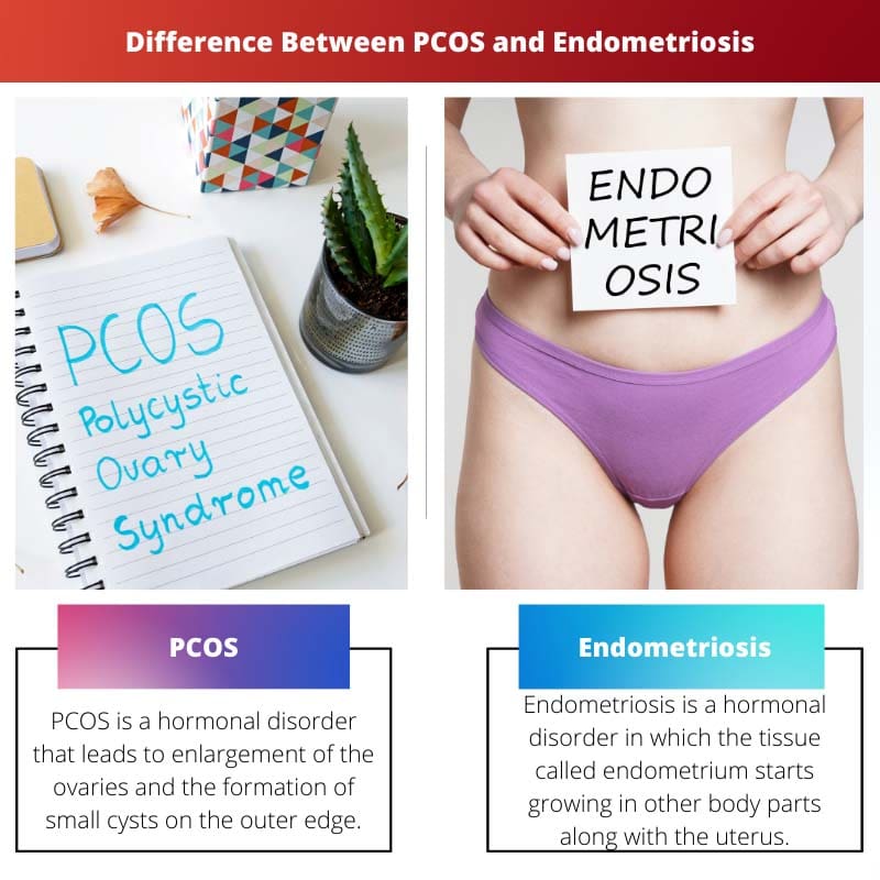 Sự khác biệt giữa PCOS và lạc nội mạc tử cung