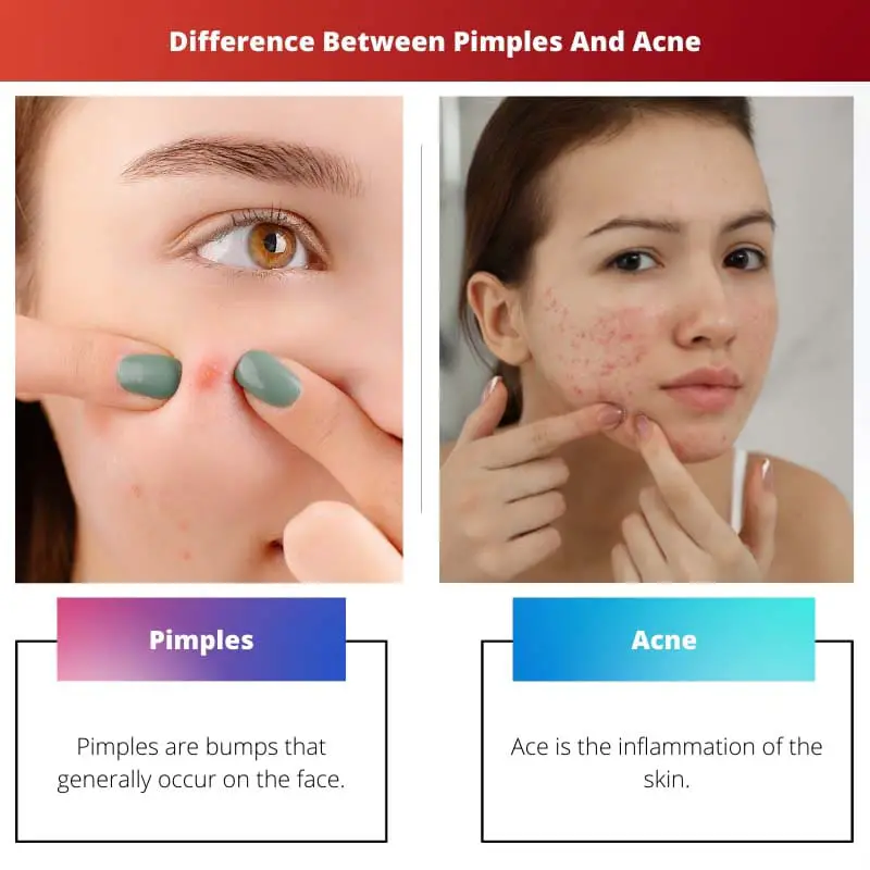 Difference Between Pimples And Acne