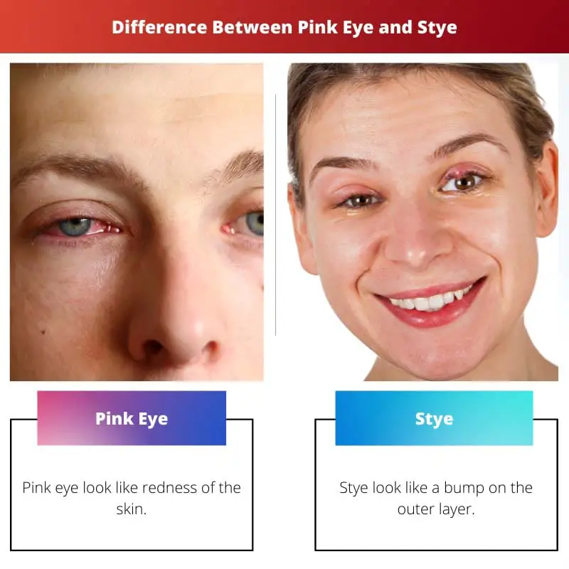 الفرق بين العين الوردية و Stye