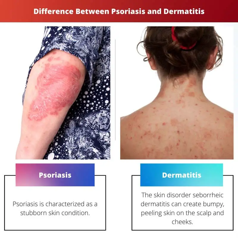 Verschil tussen psoriasis en dermatitis