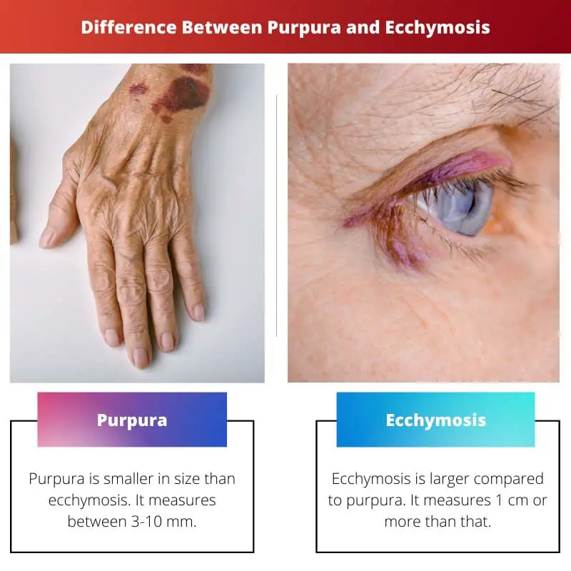 Sự khác biệt giữa Purpura và Ecchymosis
