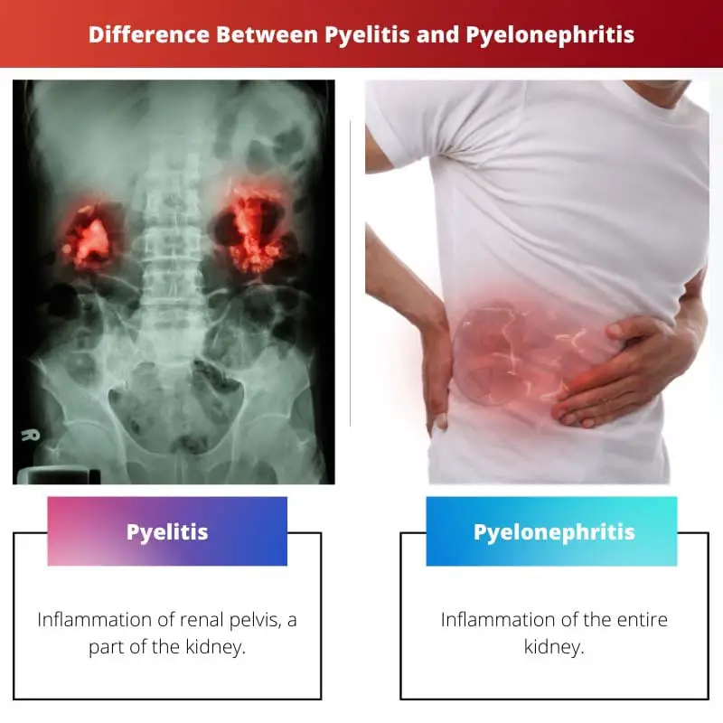 Difference Between Pyelitis and Pyelonephritis