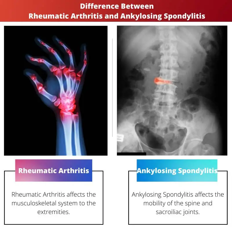 Разница между ревматическим артритом и анкилозирующим спондилитом