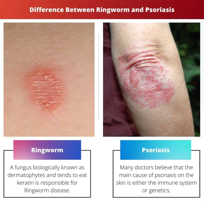 Difference Between Ringworm and Psoriasis