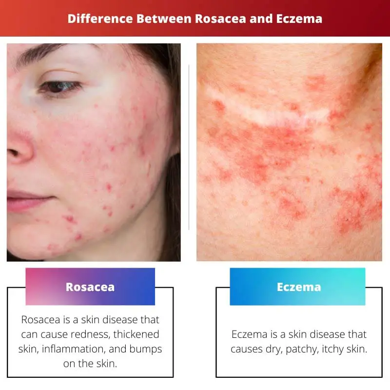 Differenza tra rosacea ed eczema