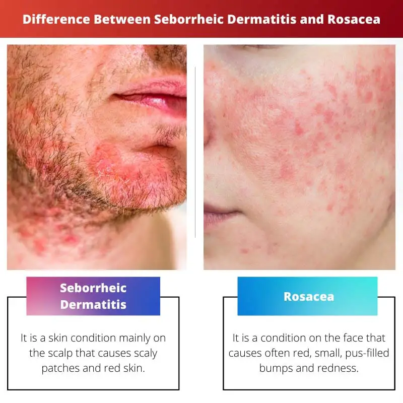 Difference Between Seborrheic Dermatitis and Rosacea