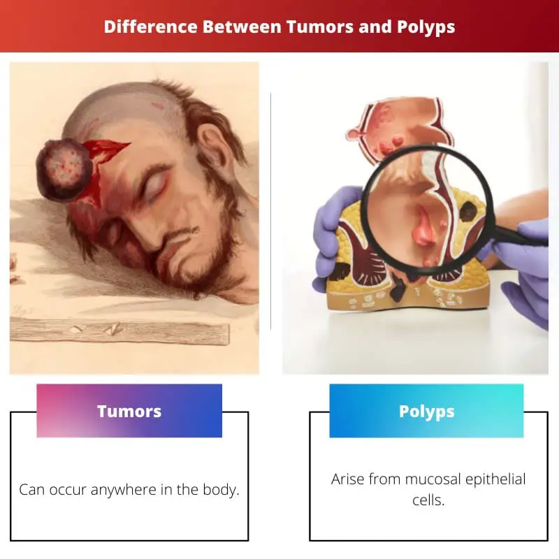 Difference Between Tumors and Polyps