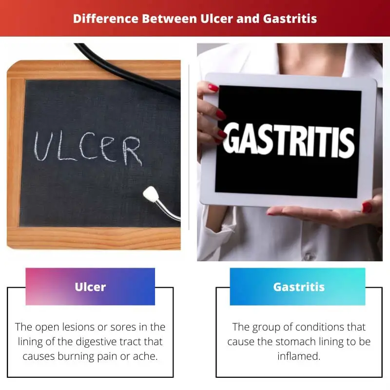 Diferencia entre úlcera y gastritis